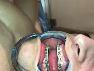 Cuming on my own Braces