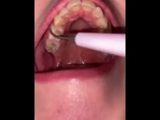 Ultrasonic Teeth Cleaning. Teeth Fetish.