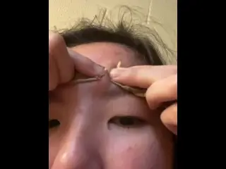 Popping Pimple :)