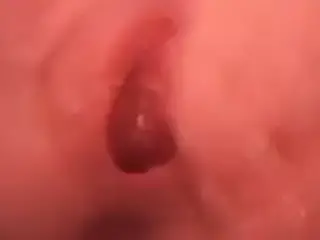 Pregnant cervix prolapse 2