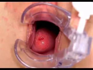 Gyno-1