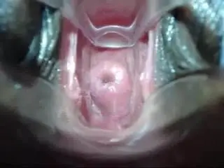 Shallow cervix penetration