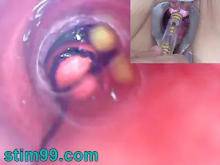 Mature Woman, Peehole Endoscope Camera in Bladder with Balls