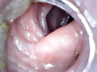 Anal endoscope part 2