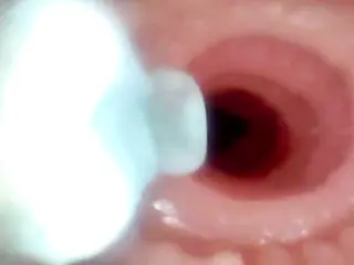 A detailed examination of Lopuza93 oral cavity and anal area using an endoscope camera.